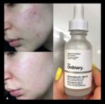 سرم نیاسینامید اوردینری ضد جوش Ordinary Niacinamide Zinc